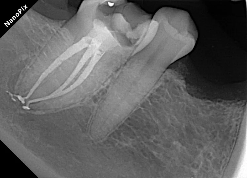 Severely Curved Roots in Lower First Molar | Endodontic Case | ARCENDO