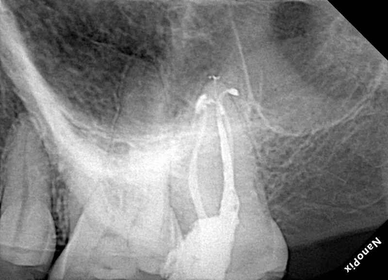 Curved Roots Rct Curved Roots in Upper Second Molar | Endodontic Case | ARCENDO
